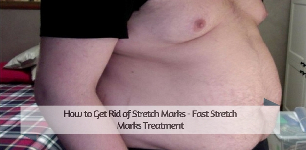 How to Get Rid of Stretch Marks - Fast Stretch Marks Treatment