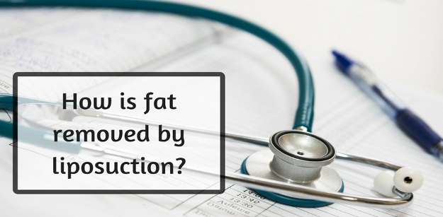 How is fat removed by liposuction