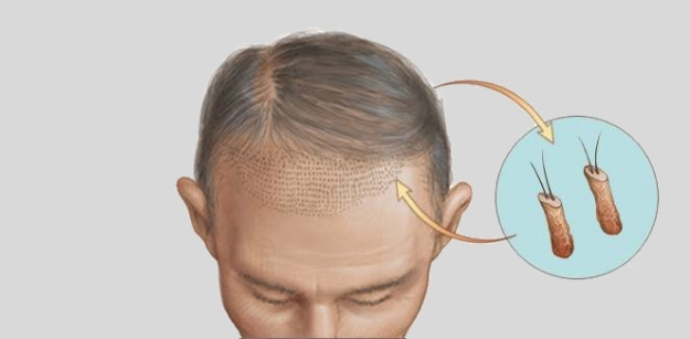 Misconceptions Regarding Hair Transplantation