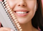 Essential Tips on How You Can Preserve Your Dental Veneers in Sydney