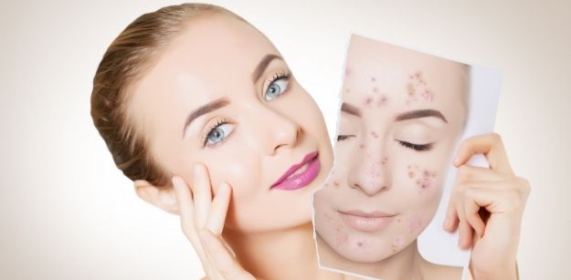 Inexpensive Ways to Treat Acne at Home