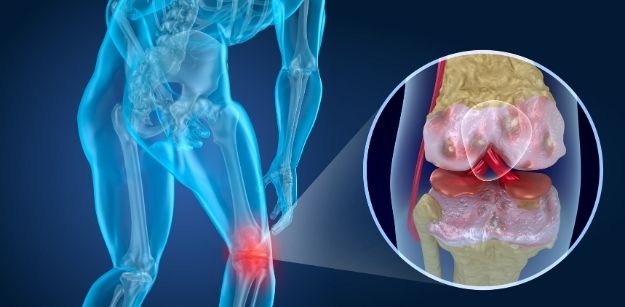 Knee Pain - Symptoms, Causes and Remedies