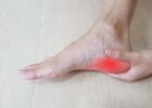 Five Treatments to Use on Plantar Fasciitis for Quick Relief