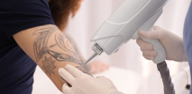 How to Pursue Tattoo Removal as a Career