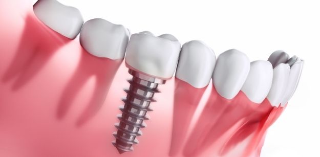 The Benefits of Dental Implants